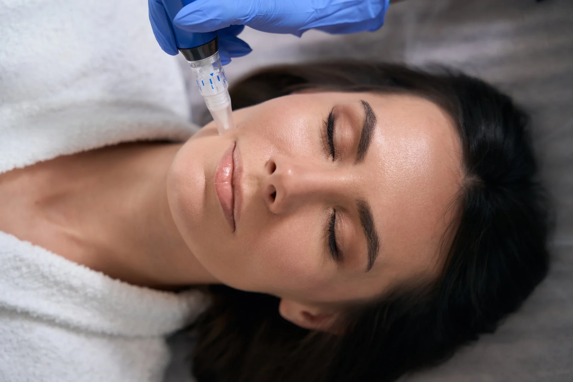 Xcellaris Pro Twist-microneedling av ansiktet i klinikk